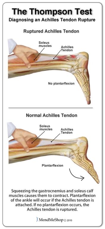 special test for achilles tendonitis